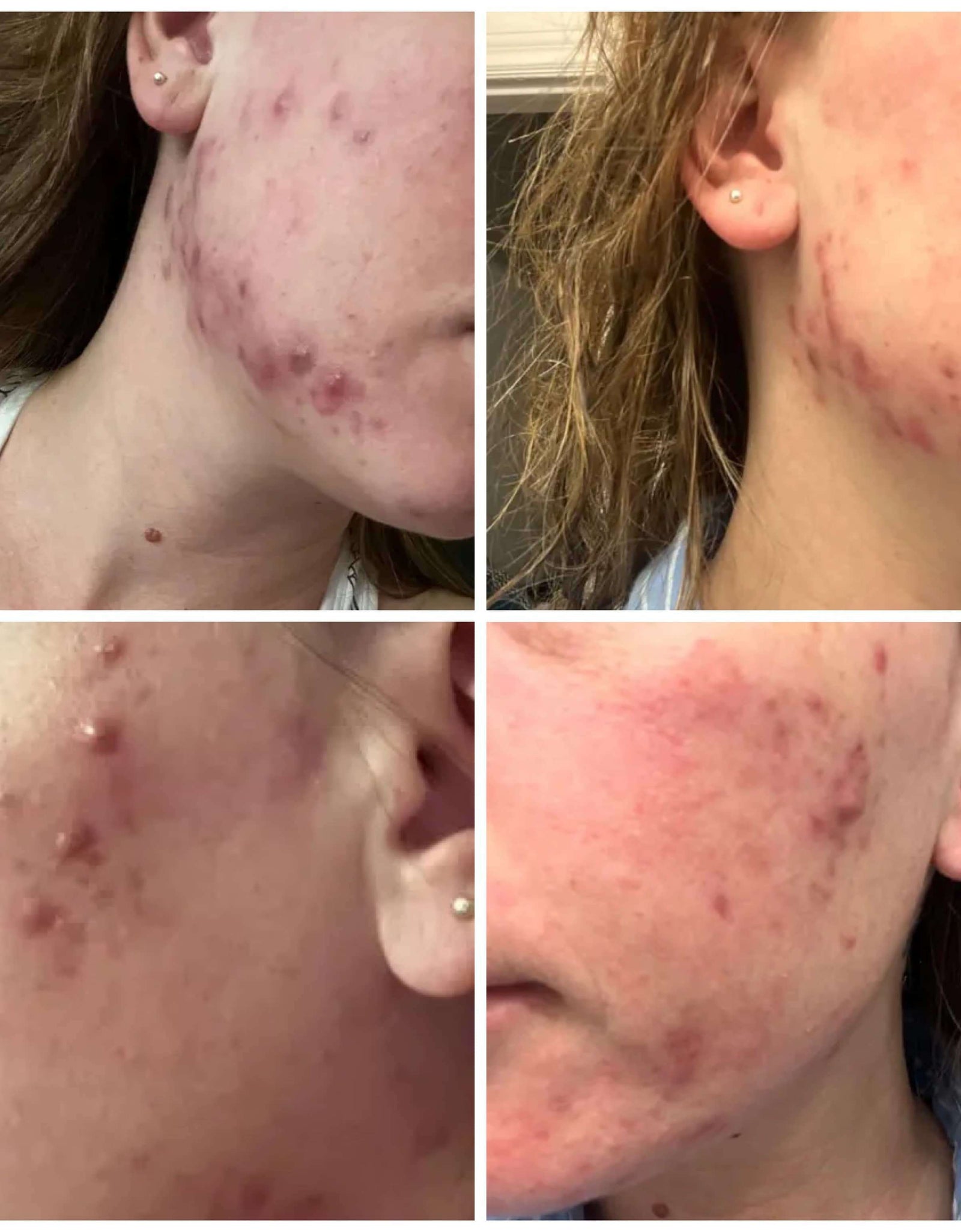 BalanC Pregnancy Acne Toner by The Spoiled Mama