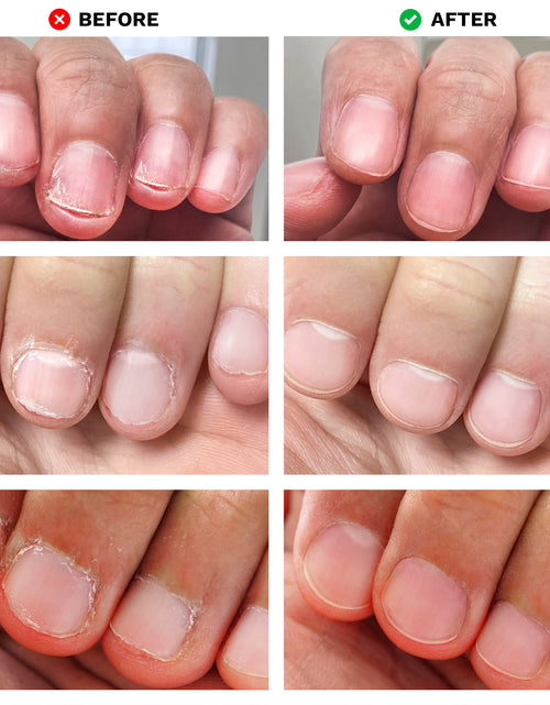 Load image into Gallery viewer, No Bite Nail Recovery by LONDONTOWN
