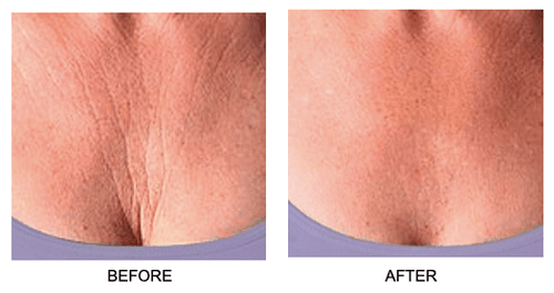 Load image into Gallery viewer, Skin Plumping Chest Mask [Reusable] by Dreambox Beauty
