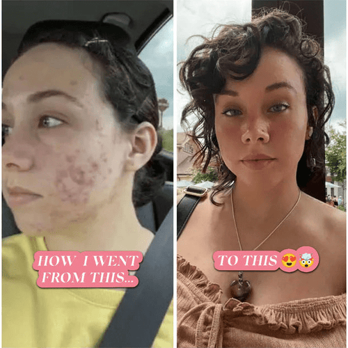Load image into Gallery viewer, BalanC Pregnancy Acne Toner by The Spoiled Mama
