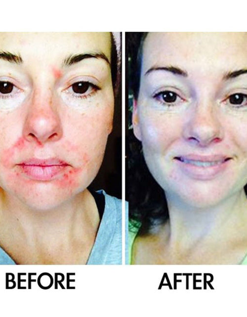 Load image into Gallery viewer, SkinSanity® Dual Acne Serum – All-Natural 1 fl oz by Best Clean Beauty
