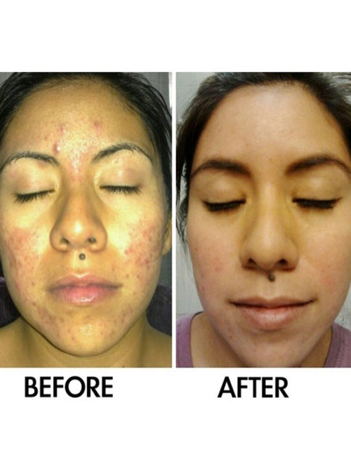 Load image into Gallery viewer, SkinSanity® Acne Treatment - Clear Skin Results Regimen by Best Clean Beauty
