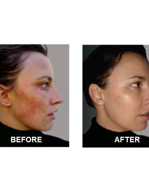 Load image into Gallery viewer, SkinSanity® Acne Treatment - Clear Skin Results Regimen by Best Clean Beauty

