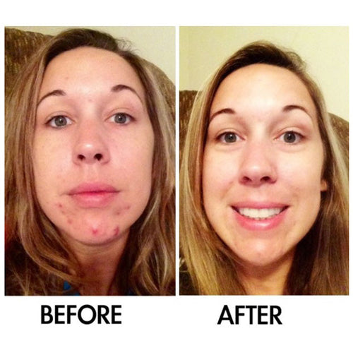 Load image into Gallery viewer, SkinSanity® Dual Acne Serum – All-Natural 1 fl oz by Best Clean Beauty
