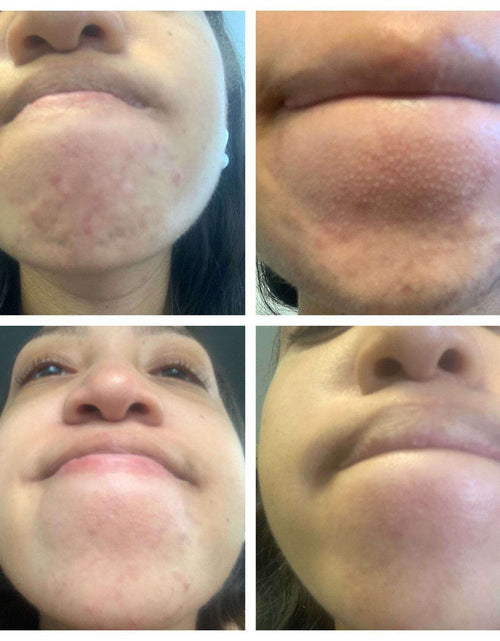 Load image into Gallery viewer, BalanC Pregnancy Acne Toner by The Spoiled Mama

